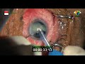 Hard cataract surgery with a short time 1399