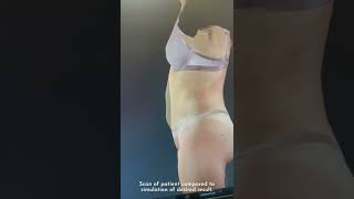 Vectra 3D Imaging Used to Plan Body Contouring Procedure Net Worth