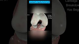 آلام الركبة والتهاب المفاصل | فهم التهاب المفاصل وعلاجه وعلاجه