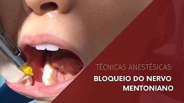 Como anestesiar o nervo Mentual?