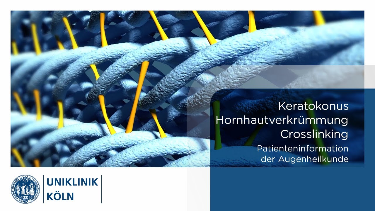  Update Uniklinik Köln | Augenklinik: Keratokonus - Crosslinking Hornhautverkrümmung (Patienteninformation)