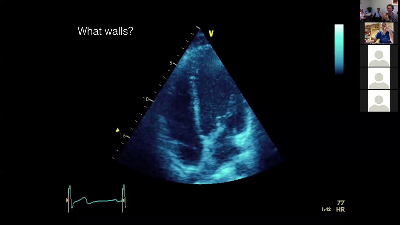 IHD and MI Complications