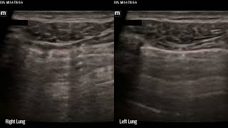 Mindray TE-X Pneumothorax Comparison Linear, Curvilinear and Phased array probes
