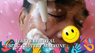 WARTS REMOVAL USING CAUTERY (KULUGO, SKINTAGS, MILIA) WARTS REMOVAL USING CAUTERY (KULUGO, SKINTAGS, MILIA)