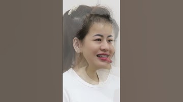 Thay đổi ngoạn mục sau niềng răng khấp móm | #shorts