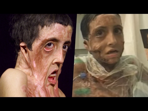 Disfigured Accident Victims - These poor people had to face surgery, transplantations and much more because of a terrible accident. Here we take a look at disfigured accident victims.