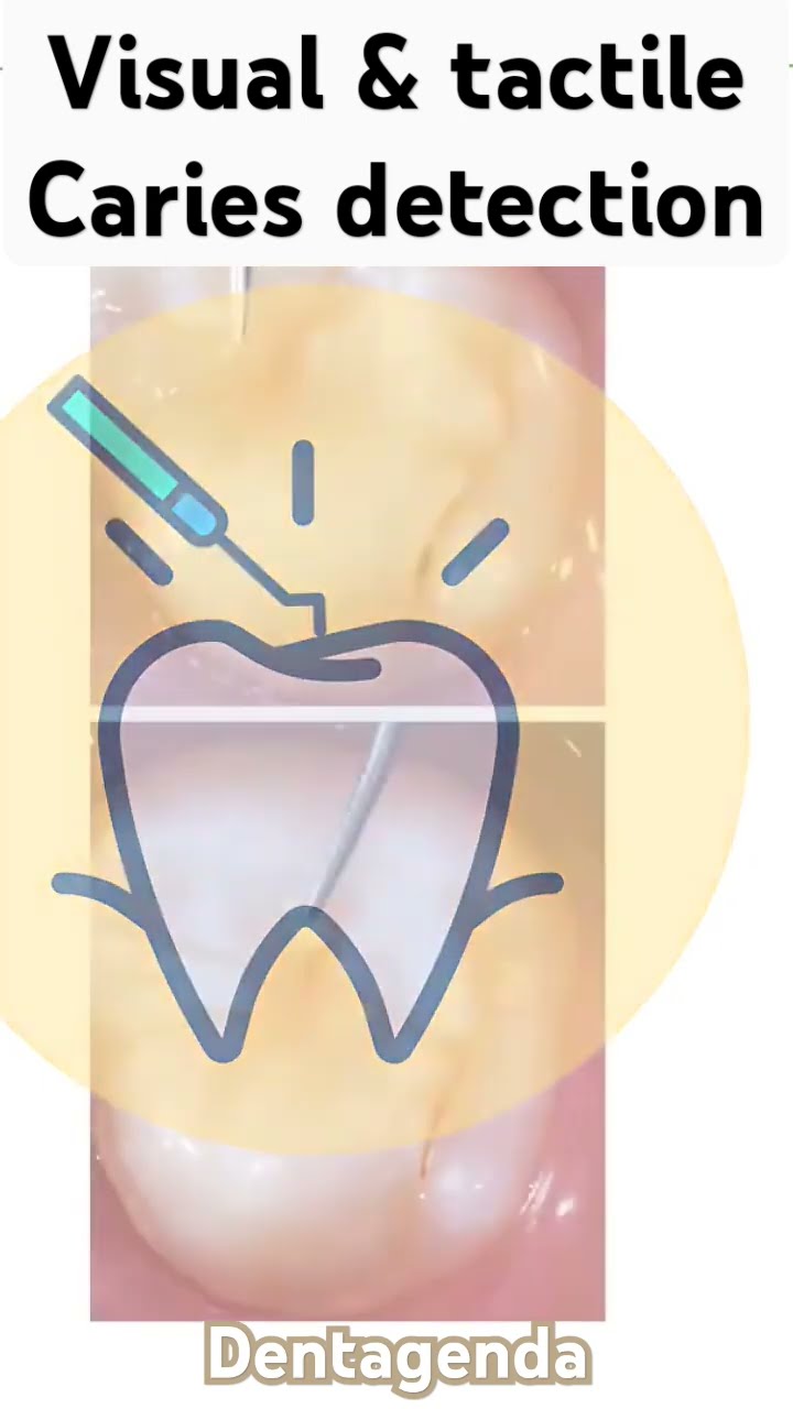 Method Control Caries Methods of caries detection-visual & tactile - YouTube