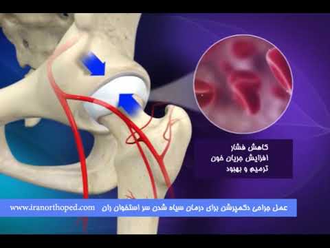 تصویری: 3 راه ساده برای جلوگیری از تعویض مفصل ران