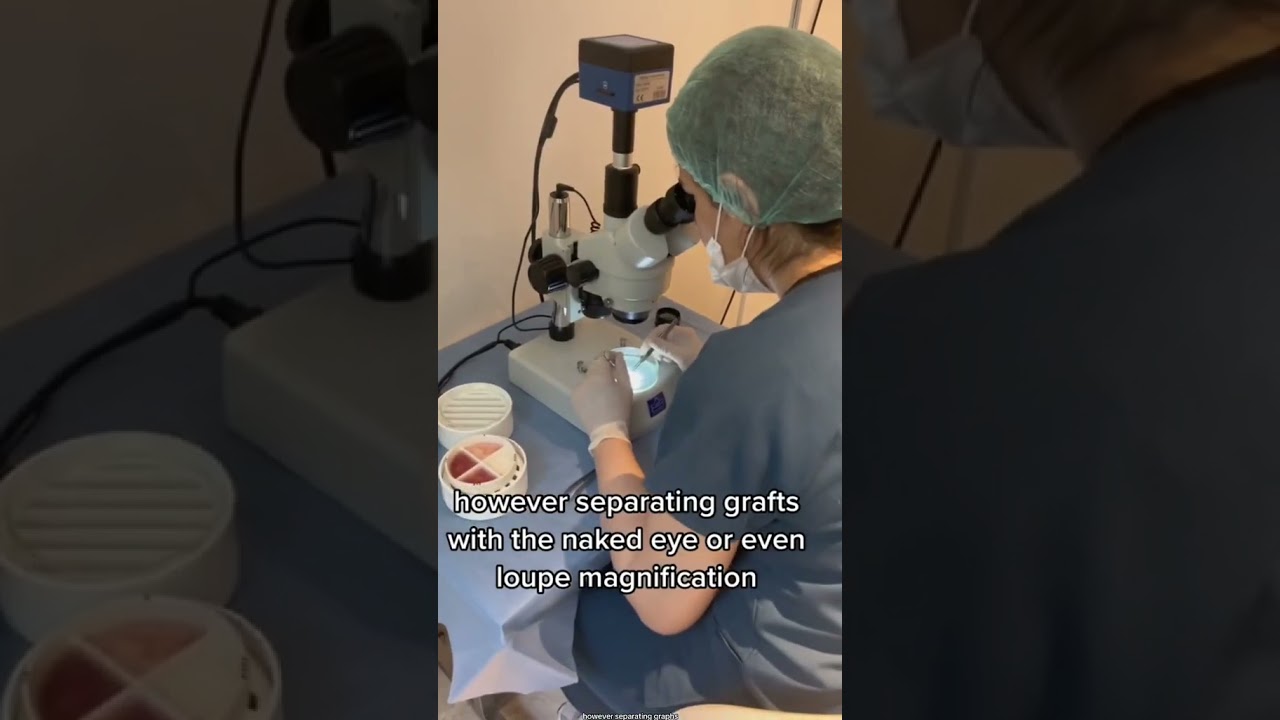 Considering a Hair Transplant? You really need to hear this