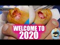 DOUBLE DAMAGED TOENAIL REMOVAL IN THE YEAR 2020