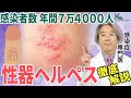 【性病】性器ヘルペスに感染するとどうなるの？原因と仕組みについて感染症の専門医が解説