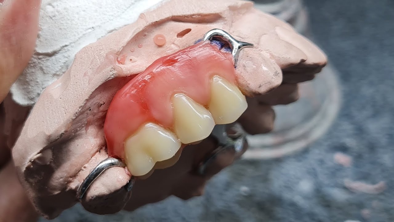 Como fazer enceramento de P.P.R! (Prótese parcial removível) Aula 01 (Prótese dentária)