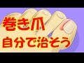 巻き爪を自宅で治療！手術になる前に自分で矯正する治し方