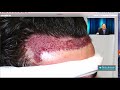 Hairline Transplant- How We Did It| Feller and Bloxham | Great Neck | NY | NJ | CT