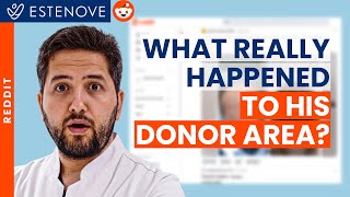 Doctor Reacts to Reddit Hair Transplant Cases!
