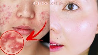 DƯỠNG DA TRỊ MỤN NGON BỔ RẺ //ACNE SKINCARE ROUTINE ft. StyleKorean screenshot 2