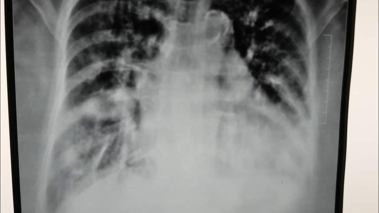 Fluid in the right horizontal fissure with pulmonary edema on chest x