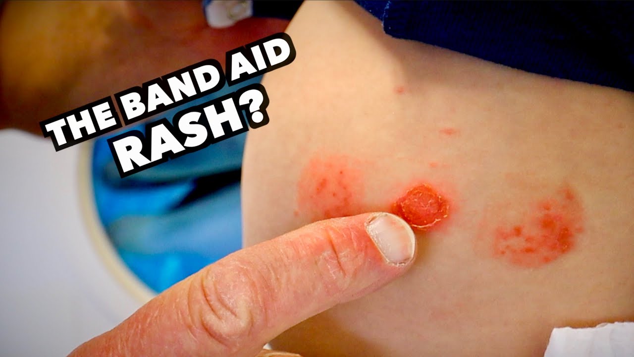 How Do You Get Rid Of A Band Aid Rash