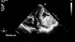 Echocardiographic Video of a Failing Pig Heart with and without Assistive device