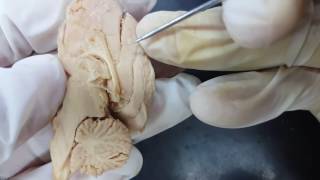 4 Median Sagittal of the Brain 1