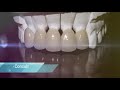 Zirconia vs. E-Max Veneer