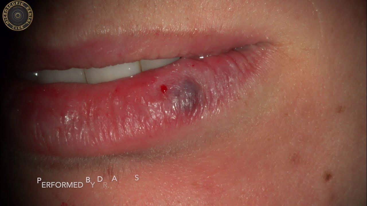 Effective Treatment For Hemangioma On Lower Lip With Laser Youtube