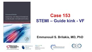 Case 153: PCI Manual - STEMI, kinked guide, VF Resimi