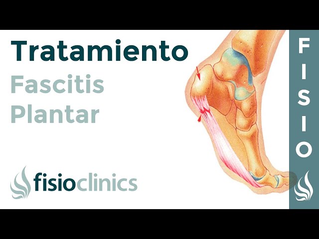 Cómo combatir la fascitis plantar - Clínica Montaño Herrera