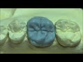 Live wax up  upper 1st molar wax up full 