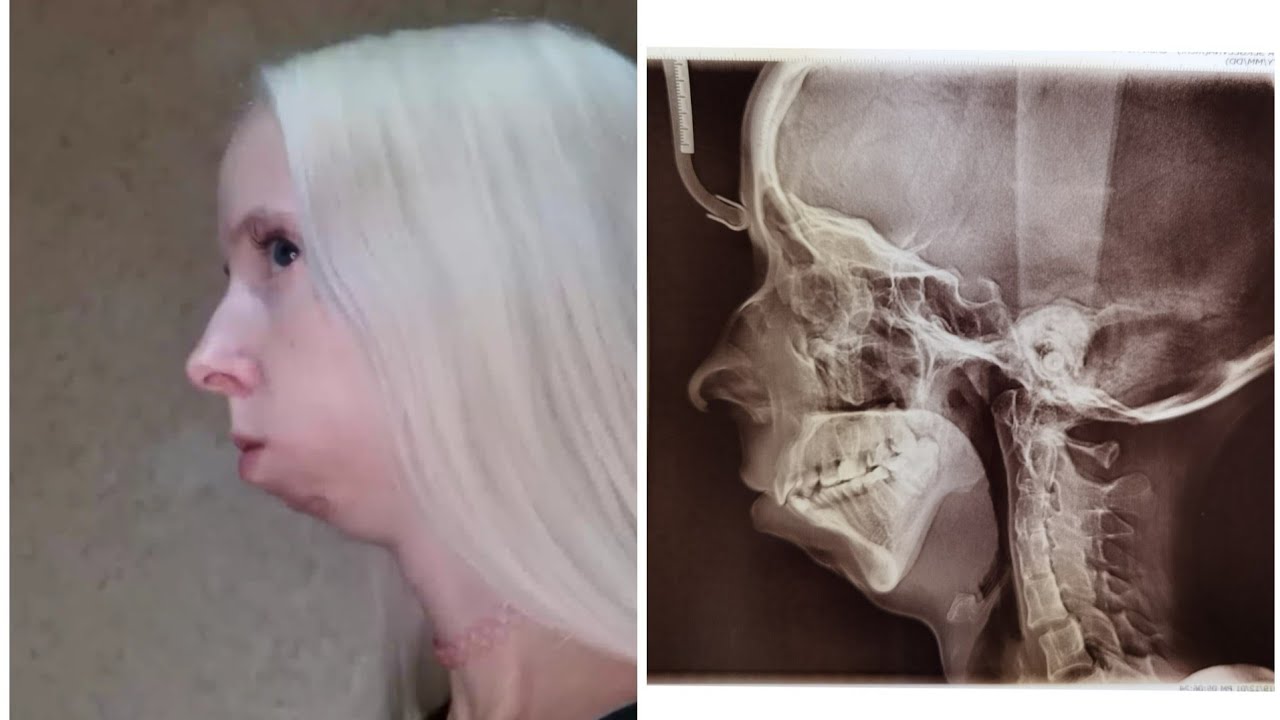 Готовлюсь к ортогнатической операции. Микрогнатия. Ретропозиция нижней ...