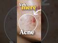 Pimples to Clear Skin 😱 Glow Up Journey #AcneToClearSkin #GlowUp