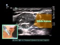 Ultrasound-Guided Interscalene Brachial Plexus Nerve Block - SonoSite.mp4