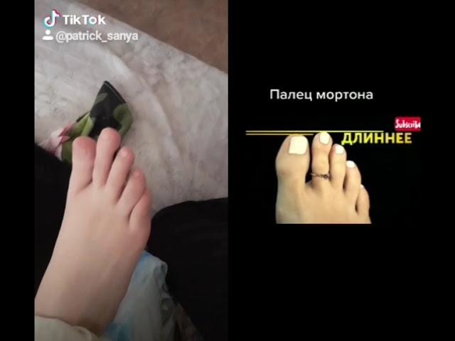 палец Мортона
