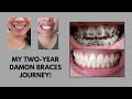 Comprehensive Damon Braces Video (Full Two-Year Process w/ Updates)