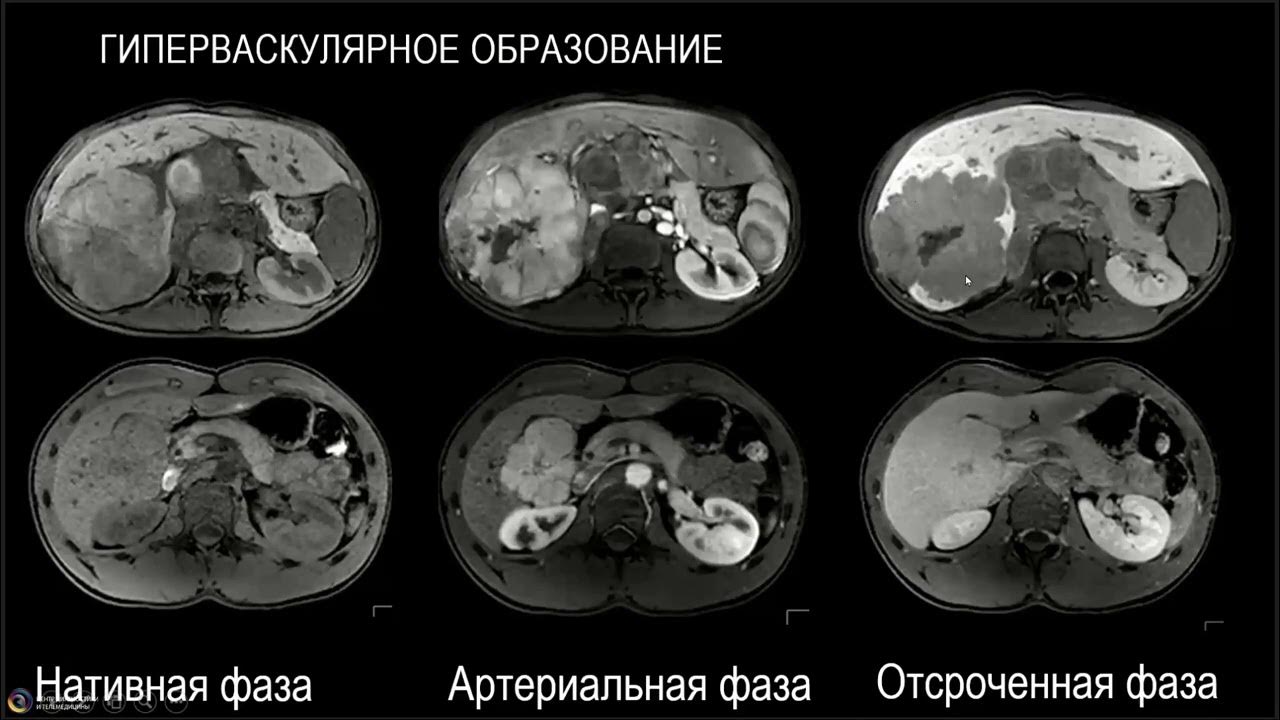 Гиперваскулярное образование печени. Гиперваскулярные образования печени на кт. Гиперваскулярные образования печени на мрт. Гиповаскулярные образование в печени мрт. Гиповаскулярные метастазы печени мрт.