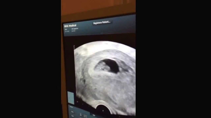 IVF #1 cykeln Del 12; Gravid! Det första Ultraljudet i v 8 (7+6)