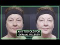 Can You Be Too Old For Dermal Fillers?