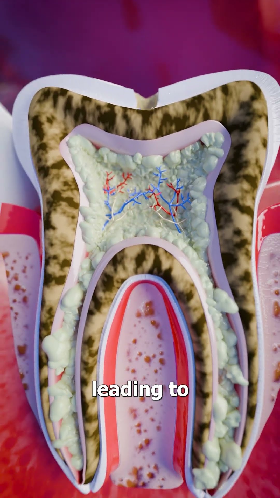 How A Tooth Abscess Develops ?