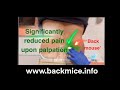 Painful back mouse subfascial fat herniation treated with the msdn technique