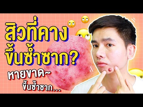 สิวที่คาง สิวอุดตัน สิวอักเสบ สิวขึ้นซ้ำซาก รักษายังไงให้หายขาด | นุชา HAPPY NUCHA