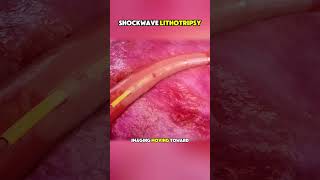They Use Sound Waves Inside Your Arteries… To Break Calcium 😳 (Shockwave IVL Explained) #shockwavei