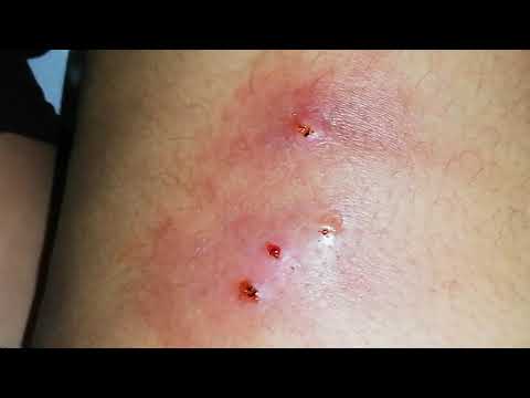Heridas en la rodilla infectadas