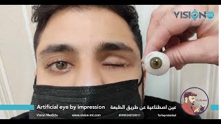 عين اصطناعية عن طريق الطبعة Artificial eye by impression