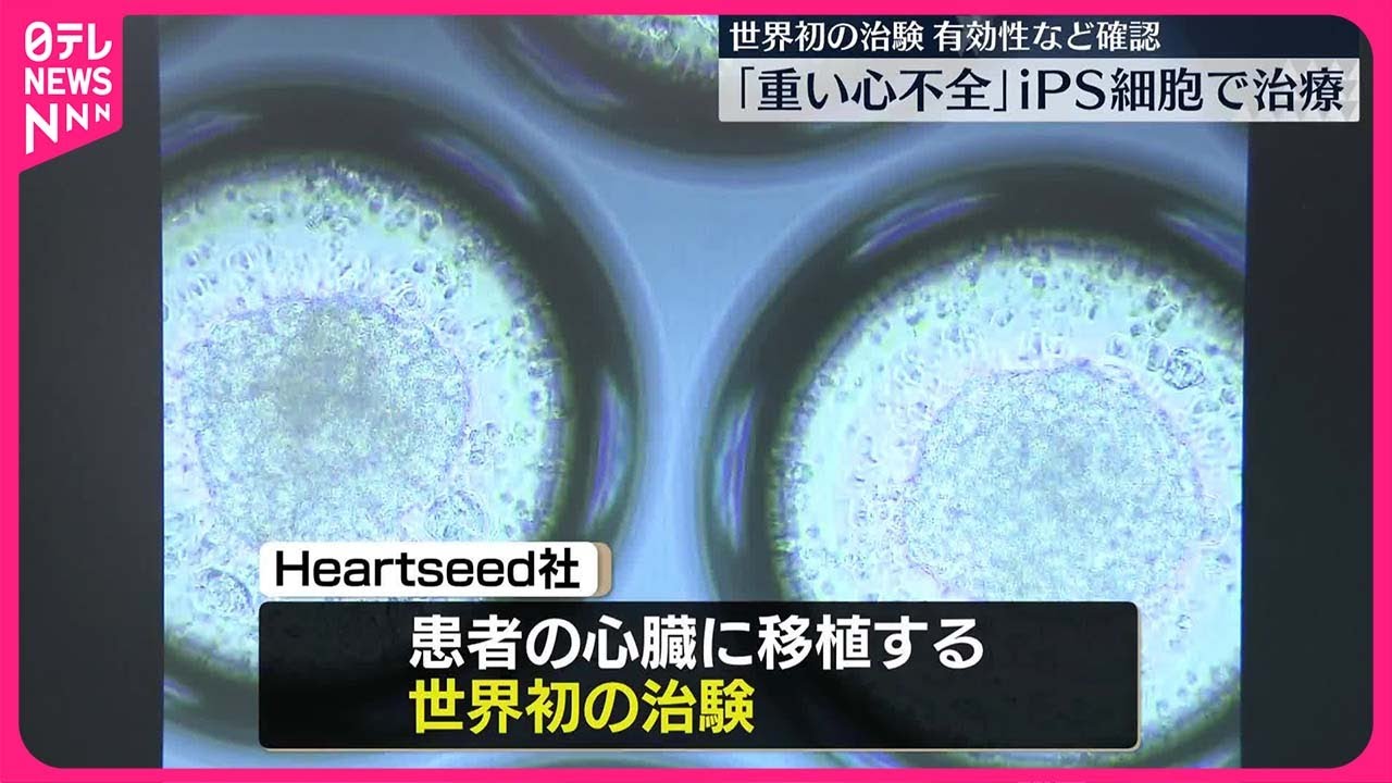 重い心不全」iPS細胞で治療】世界初の治験…有効性など確認 慶応大学