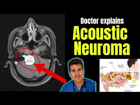 Video: Vai akustiskās neiromas ir labdabīgas?