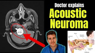 Doctor explains Acoustic Neuroma - including symptoms, investigations and treatment!