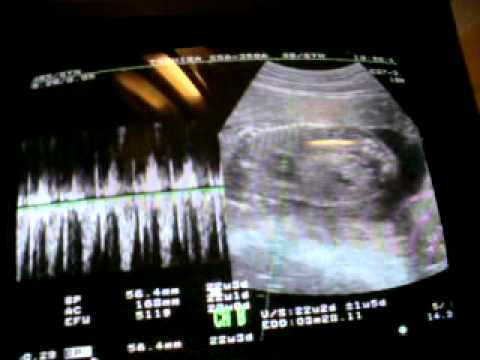 2010-11-24產檢.mp4