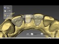 Digital maryland bridge  inlab dentsply sirona cad cam