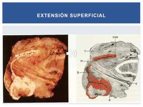 CARCINOMA DE PENE