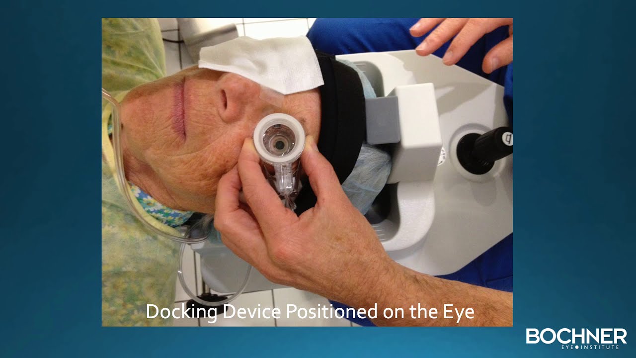 Femtosecond Laser Eye Surgery Toronto Bochner Eye YouTube